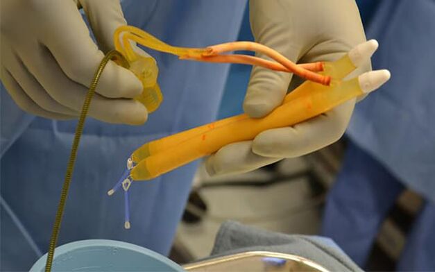 Implantaten in de penis